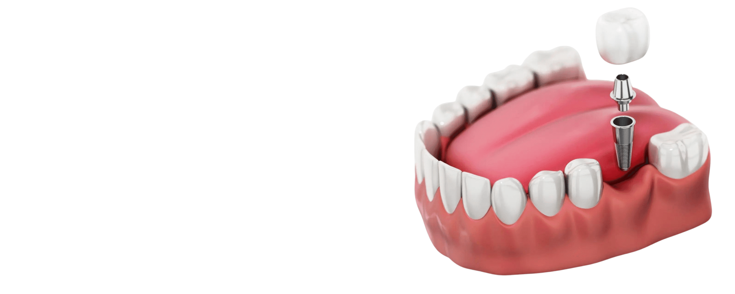 Single Tooth Implant Single Tooth Implant