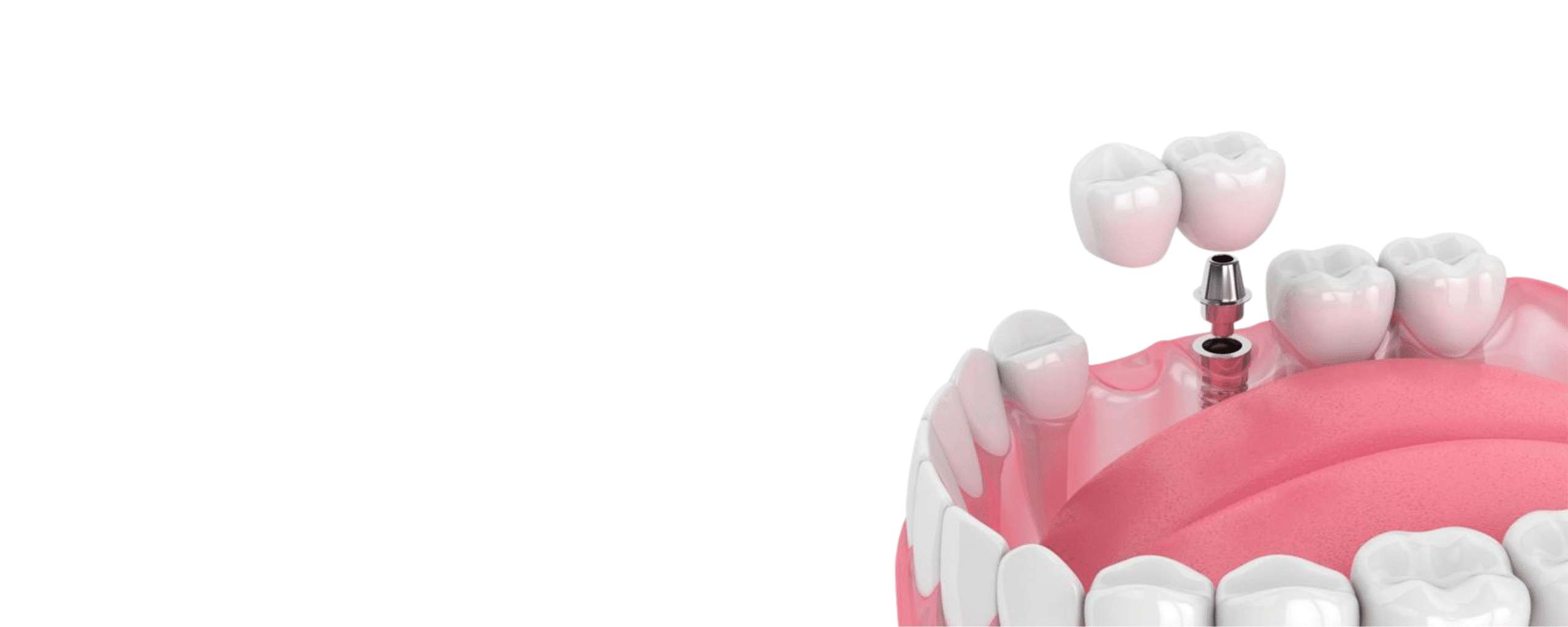 Two Teeth Bridge on One Implant Two Teeth Bridge on One Implant