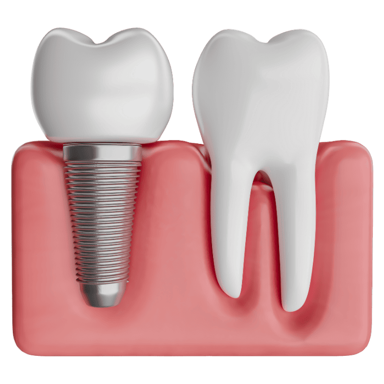 Close-up of dental implant and natural tooth on gum line.