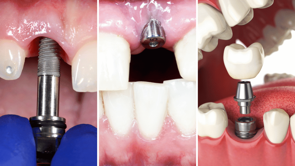 Dental implant procedure for tooth replacement and restoration.