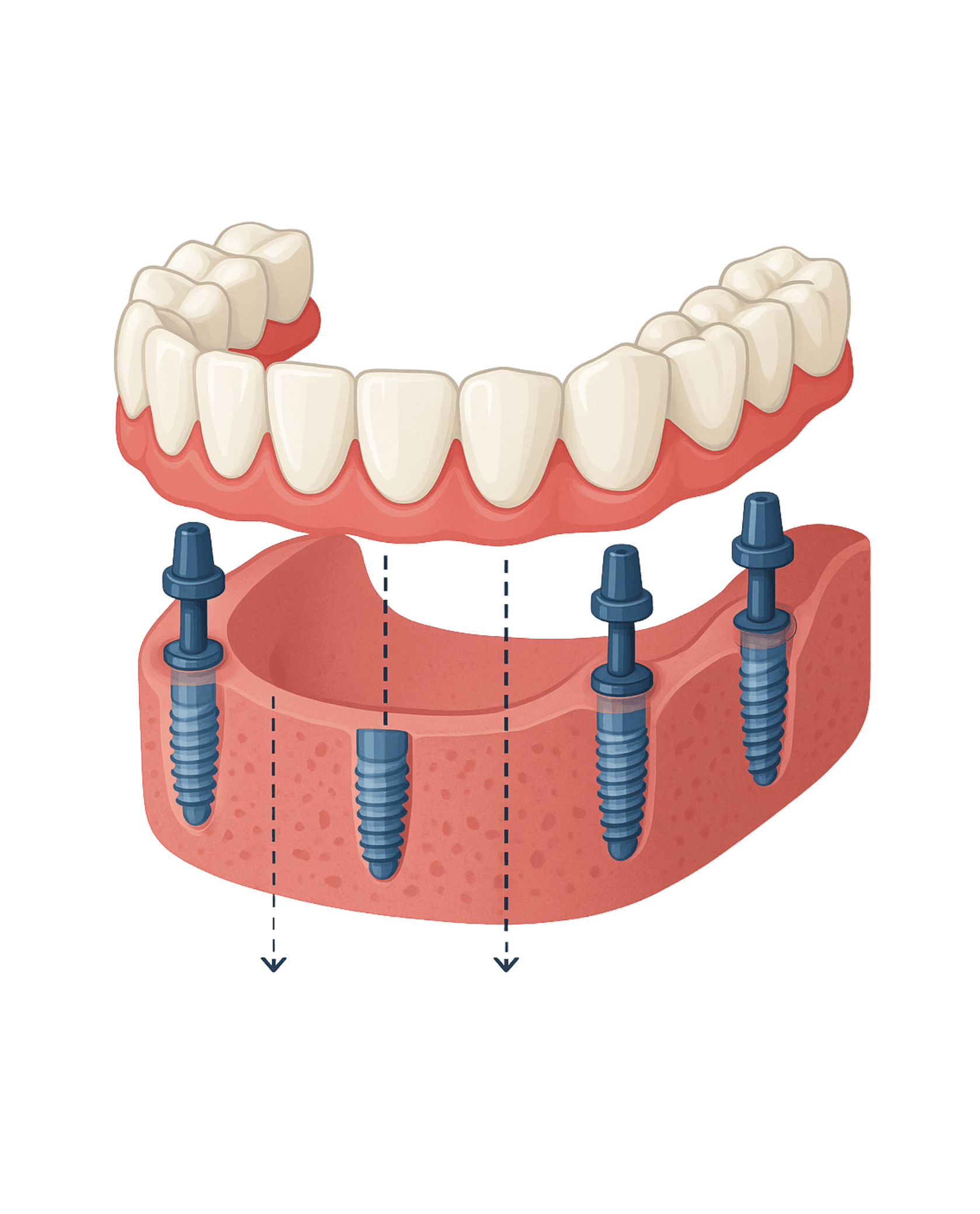 Dental implant reconstruction with screws and prosthetic teeth.