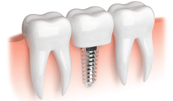 High-quality dental implant procedure for missing teeth and smile restoration.