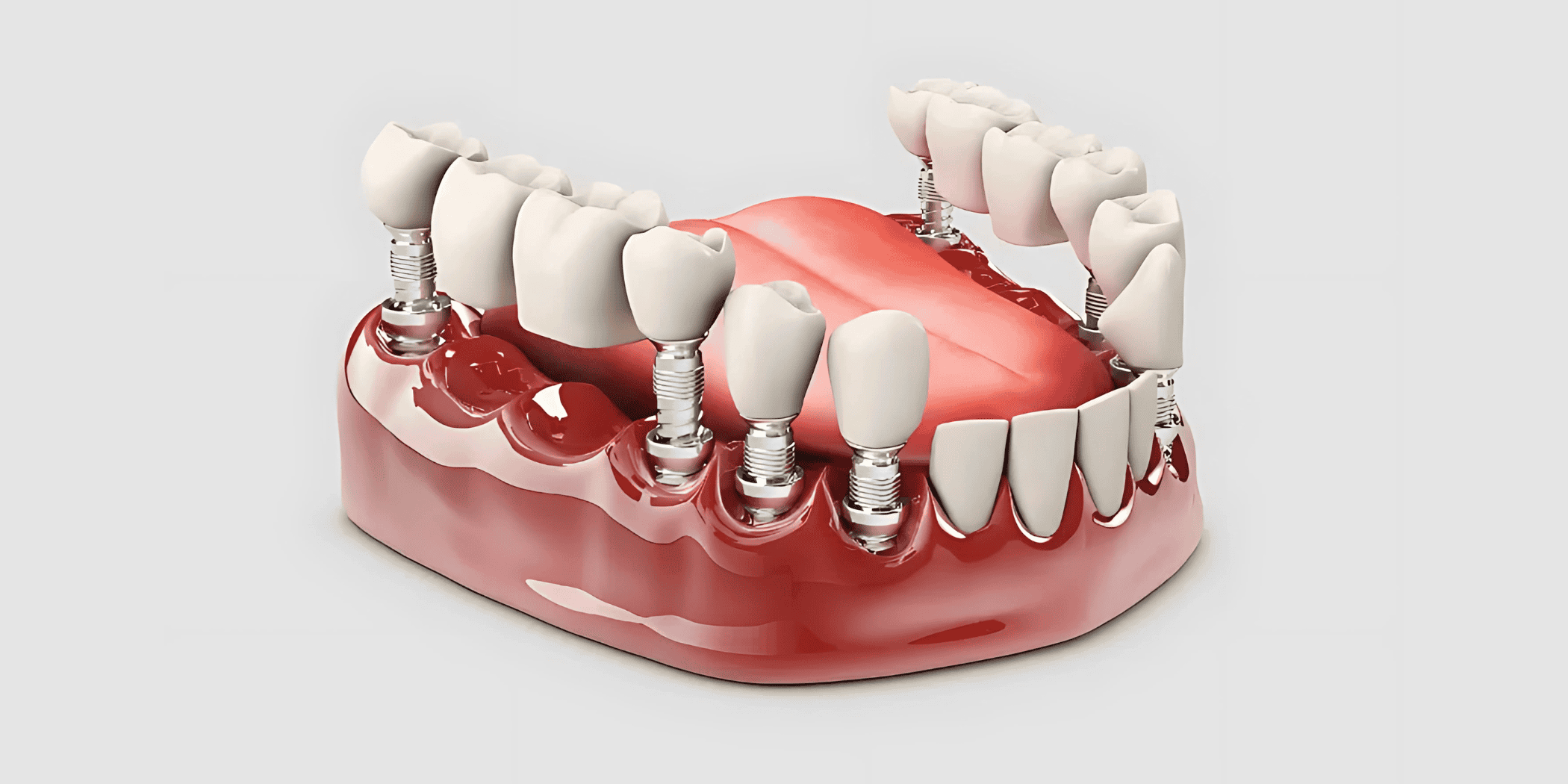 High-quality dental implant overdentures for improved smile and confidence.