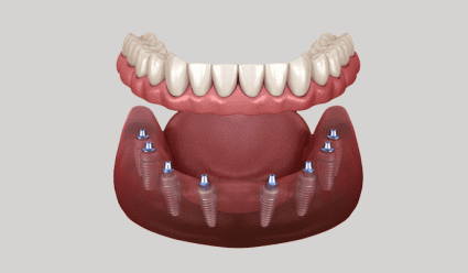 High-quality dental implant dentures for improvedoral health and smile restoration.