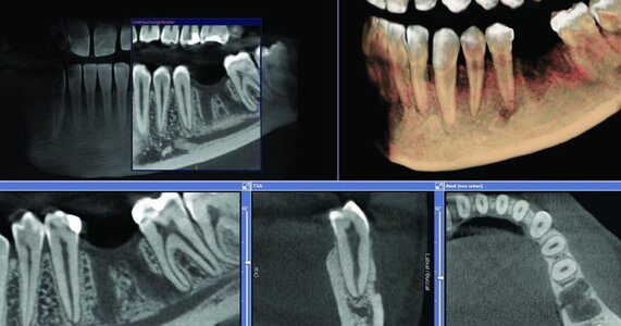 CBCT