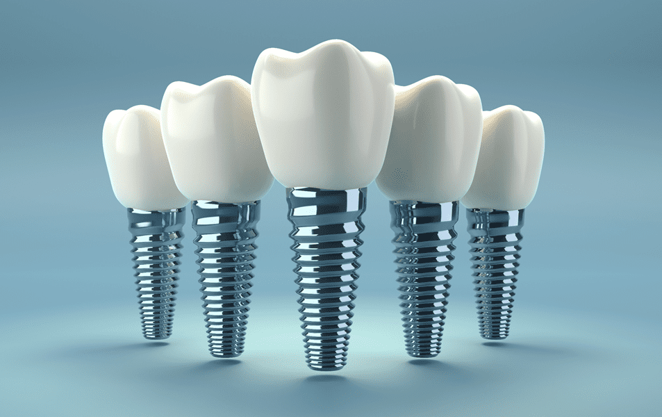 dental implant timeline