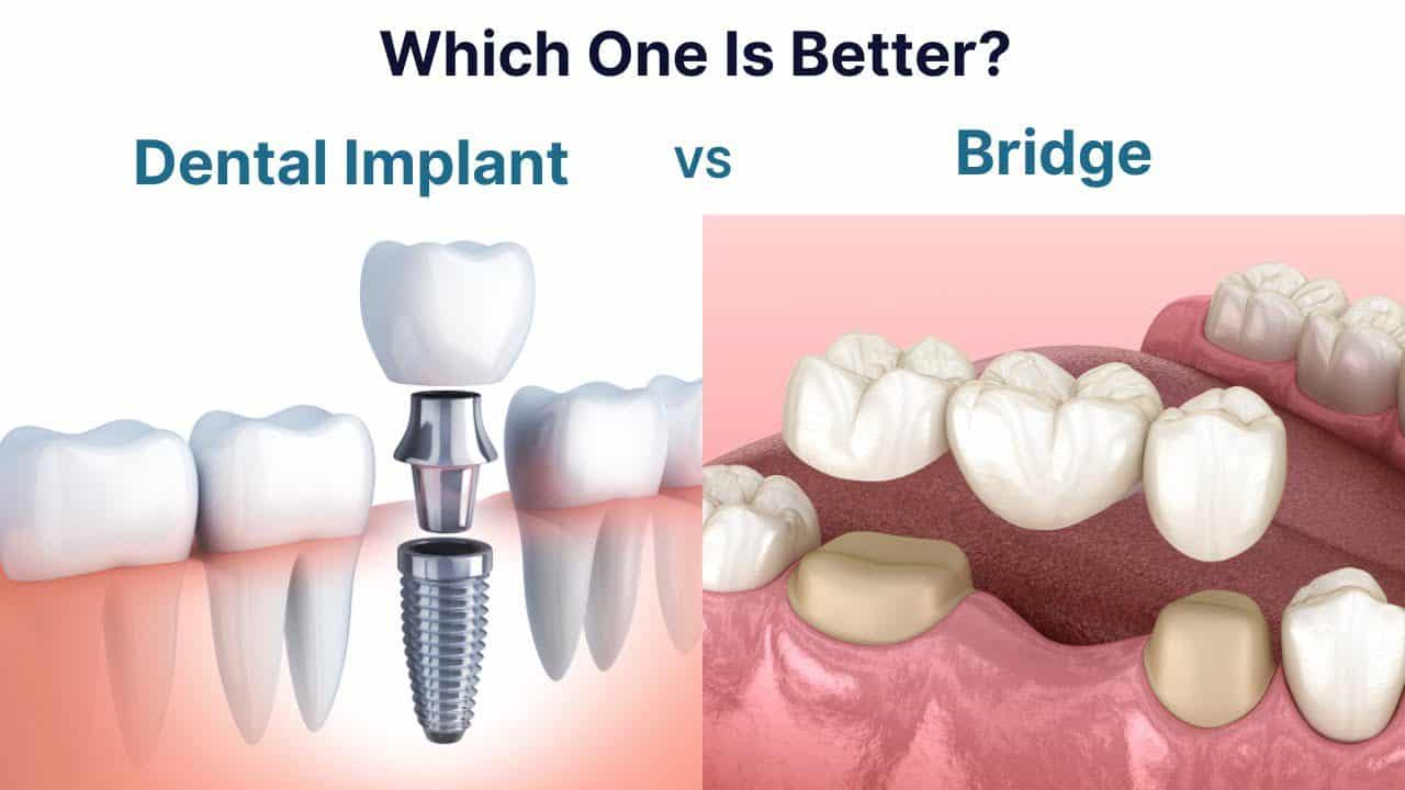 Implant or Bridge