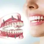 Full Mouth Dental Implants